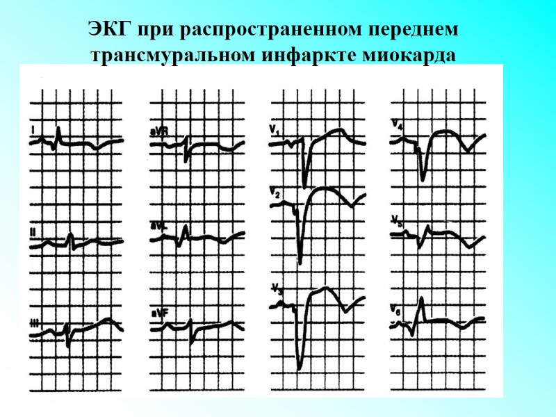 ЭКГ при распространенном переднем трансмуральном инфаркте миокарда